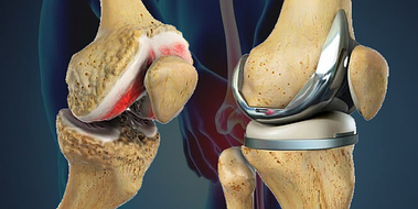 Orthopaedics & Joint Replacement