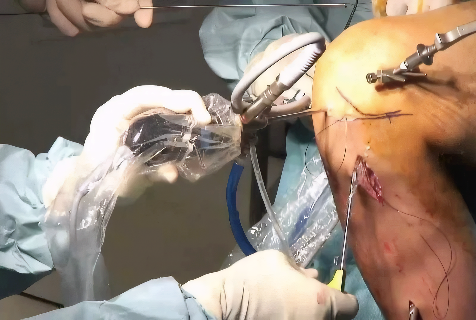Arthrocopy